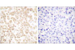 Peptide - +Immunohistochemical analysis of paraffin-embedded human breast carcinoma tissue using Fra-2 antibody (#C0197).