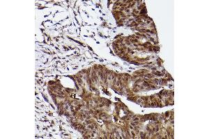 Immunohistochemistry of paraffin-embedded human colon carcinoma using ERK1 Rabbit mAb  at dilution of 1:100 (40x lens).