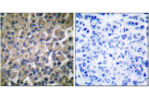 Immunohistochemical analysis of paraffin-embedded human breast carcinoma tissue using GRP78 antibody. (GRP78 anticorps)