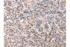 The image on the left is immunohistochemistry of paraffin-embedded Human liver cancer tissue using ABIN7192749(TCERG1L Antibody) at dilution 1/30, on the right is treated with synthetic peptide. (TCERG1L anticorps)