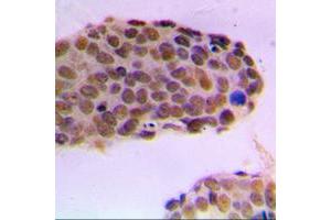 Immunohistochemical analysis of RACK7 staining in human breast cancer formalin fixed paraffin embedded tissue section.