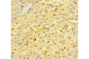 Immunohistochemistry of paraffin-embedded human melanoma using ABIN7176008 at dilution of 1:100 (ZSCAN29 anticorps  (AA 1-300))