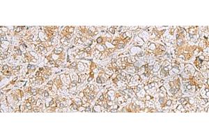 Immunohistochemistry of paraffin-embedded Human liver cancer tissue using FERMT1 Polyclonal Antibody at dilution of 1:30(x200) (FERMT1 anticorps)