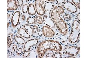 Immunohistochemical staining of paraffin-embedded Carcinoma of liver tissue using anti-BTK mouse monoclonal antibody. (BTK anticorps)