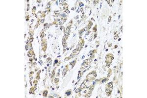 Immunohistochemistry of paraffin-embedded human gastric cancer using IFNL3 antibody at dilution of 1:100 (40x lens). (IL28B anticorps)