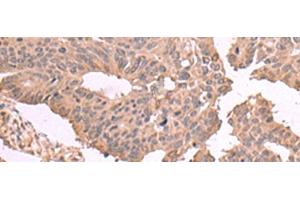 Immunohistochemistry of paraffin-embedded Human colorectal cancer tissue using MAGEC2 Polyclonal Antibody at dilution of 1:60(x200)