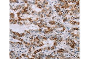 Immunohistochemistry of Human cervical cancer using NMT1 Polyclonal Antibody at dilution of 1:45
