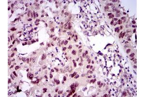 Immunohistochemical analysis of paraffin-embedded endometrial cancer tissues using TP53BP1 mouse mAb with DAB staining. (TP53BP1 anticorps  (AA 574-773))