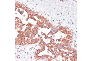 Immunohistochemistry of paraffin-embedded Human mammary cancer using PGD antibody (ABIN6127314, ABIN6145502, ABIN6145503 and ABIN6223639) at dilution of 1:100 (40x lens). (PGD anticorps  (AA 184-483))