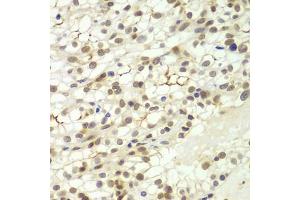 Immunohistochemistry of paraffin-embedded human kidney cancer using LHX4 antibody (ABIN5975324) at dilution of 1/100 (40x lens). (LHX4 anticorps)