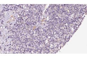 ABIN6273176 at 1/100 staining Human lymph cancer tissue by IHC-P.