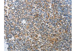 The image on the left is immunohistochemistry of paraffin-embedded Human tonsil tissue using ABIN7189642(AD7C-NTP Antibody) at dilution 1/25, on the right is treated with synthetic peptide. (AD7C-NTP anticorps)