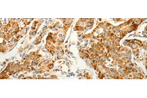 Immunohistochemistry of paraffin-embedded Human lung cancer tissue using VDAC2 Polyclonal Antibody at dilution of 1:25(x200) (VDAC2 anticorps)
