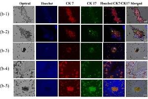 On-chip cholangiocarcinoma (CCA) cell capture and consequent immunofluorescence (IF) staining with CCA-specific biomarkers (CK7 and CK17).