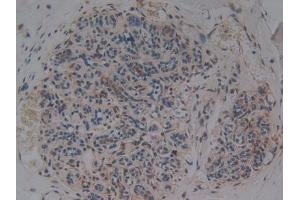 Detection of AAP in Human Breast cancer Tissue using Polyclonal Antibody to Alanine Aminopeptidase (AAP)