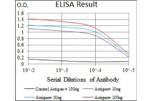Immunohistochemical analysis of paraffin-embedded rectum cancer tissues using T antibody with DAB staining. (T Antigen (AA 257-309) anticorps)