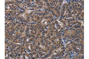 The image on the left is immunohistochemistry of paraffin-embedded Human thyroid cancer tissue using ABIN7191819(PDE4A Antibody) at dilution 1/40, on the right is treated with synthetic peptide. (PDE4A anticorps)