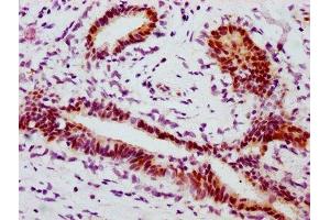 IHC image of ABIN7127753 diluted at 1:100 and staining in paraffin-embedded human breast cancer performed on a Leica BondTM system.