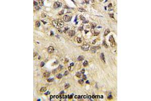 Formalin-fixed and paraffin-embedded human prostate carcinoma tissue reacted with MYC polyclonal antibody  , which was peroxidase-conjugated to the secondary antibody, followed by DAB staining. (c-MYC anticorps  (Thr58))