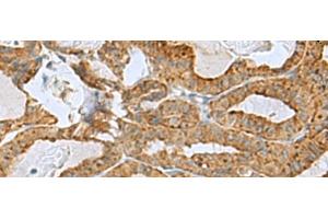 Immunohistochemistry of paraffin-embedded Human thyroid cancer tissue using RPL10A Polyclonal Antibody at dilution of 1:50(x200) (RPL10A anticorps)
