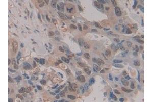Detection of HSPA1A in Human Breast cancer Tissue using Polyclonal Antibody to Heat Shock 70 kDa Protein 1A (HSPA1A)