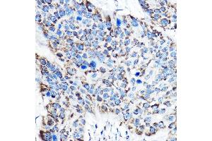 Immunohistochemistry of paraffin-embedded human esophageal cancer using OAT Rabbit pAb (ABIN6127442, ABIN6144985, ABIN6144986 and ABIN6221831) at dilution of 1:150 (40x lens).