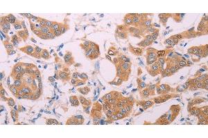 Immunohistochemistry of paraffin-embedded Human breast cancer using AGT Polyclonal Antibody at dilution of 1:30 (AGT anticorps)