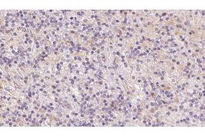 ABIN6273084 at 1/100 staining Human lymph cancer tissue by IHC-P. (UQCRFS1 anticorps  (C-Term))