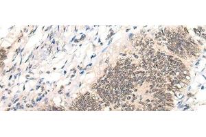 Immunohistochemistry of paraffin-embedded Human colorectal cancer tissue using AURKA Polyclonal Antibody at dilution of 1:40(x200) (Aurora A anticorps)