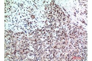 Immunohistochemistry (IHC) analysis of paraffin-embedded Human Breast Cancer, antibody was diluted at 1:200. (TP53INP2 anticorps)