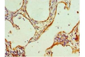 Immunohistochemistry of paraffin-embedded human cervical cancer using ABIN7155200 at dilution of 1:100