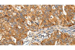 Immunohistochemistry of paraffin-embedded Human ovarian cancer using SSTR1 Polyclonal Antibody at dilution of 1:40 (SSTR1 anticorps)