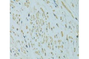Immunohistochemistry of paraffin-embedded Human uterine cancer using UGT1A6 Polyclonal Antibody at dilution of 1:100 (40x lens). (UGT1A6 anticorps)