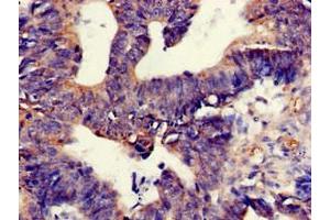 Immunohistochemistry of paraffin-embedded human colon cancer using ABIN7172340 at dilution of 1:100 (TNIK anticorps  (AA 523-714))