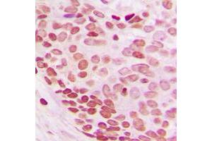Immunohistochemical analysis of NEDD8 staining in human breast cancer formalin fixed paraffin embedded tissue section.