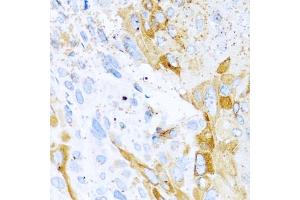 Immunohistochemistry of paraffin-embedded mouse esophageal cancer using SPINT1 antibody (ABIN5973812) at dilution of 1/100 (40x lens). (SPINT1 anticorps)