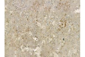 ABIN6260261 and ABIN6269348 at 1/100 staining human melanoma by IHC-P. (BIK anticorps  (N-Term))