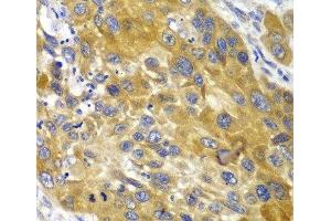 Immunohistochemistry of paraffin-embedded Human esophageal cancer using AK1 Polyclonal Antibody at dilution of 1:100 (40x lens).