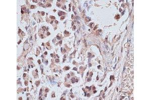Immunohistochemistry of paraffin-embedded Human lung cancer using NR5A2 Polyclonal Antibody at dilution of 1:100 (40x lens). (NR5A2 + LRH1 anticorps)
