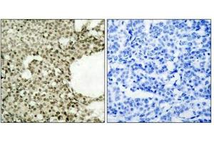 Immunohistochemical analysis of paraffin-embedded human breast carcinoma tissue using STAT1(Phospho-Ser727) Antibody(left) or the same antibody preincubated with blocking peptide(right).