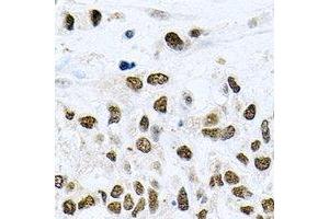 Immunohistochemical analysis of NELF-E staining in human lung cancer formalin fixed paraffin embedded tissue section. (RDBP anticorps)