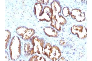 Formalin-fixed, paraffin-embedded human Prostate Carcinoma stained with PSAP Monoclonal Antibody (PASE/4LJ). (ACPP anticorps)