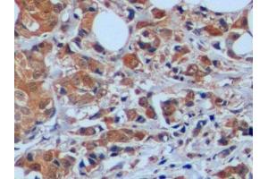 Detection of STMN1 in Human Breast cancer Tissue using Polyclonal Antibody to Stathmin 1 (STMN1)