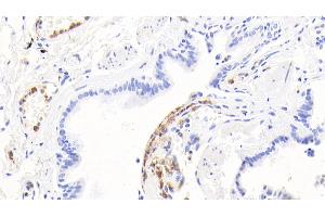 Detection of CALPRO in Human Lung Tissue using Polyclonal Antibody to Calprotectin (CALPRO) (S100A8/A9 Complex (Calprotectin) anticorps  (AA 1-114))