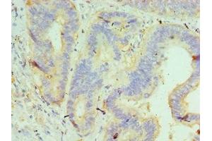 Immunohistochemistry of paraffin-embedded human colon cancer using ABIN7145505 at dilution of 1:100 (Glucuronidase beta anticorps  (AA 382-651))