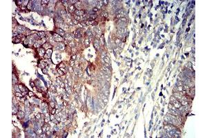 Immunohistochemical analysis of paraffin-embedded rectum cancer tissues using P2RY14 mouse mAb with DAB staining.