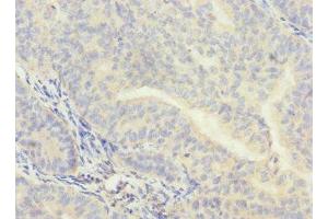 Immunohistochemistry of paraffin-embedded human endometrial cancer using ABIN7147920 at dilution of 1:100 (CPSF4 anticorps  (AA 1-244))