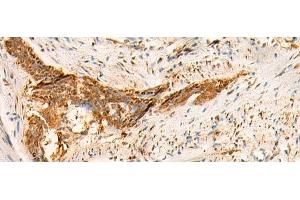 Immunohistochemistry of paraffin-embedded Human esophagus cancer tissue using SMUG1 Polyclonal Antibody at dilution of 1:50(x200) (SMUG1 anticorps)