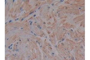 DAB staining on IHC-P; Samples: Human Prostate Tissue (MMP2 anticorps  (AA 110-660))