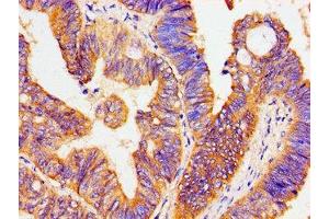 Immunohistochemistry of paraffin-embedded human colon cancer using ABIN7170044 at dilution of 1:100 (ATP1B1 anticorps  (AA 64-241))